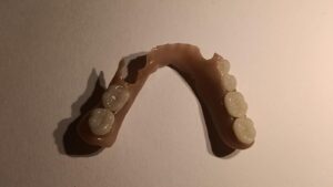 Partial DIY Denture made at home