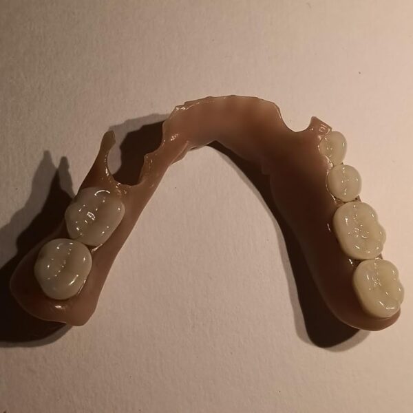 Partial DIY Denture made at home